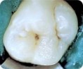 /album/dental-cavities/dental-cavity-3-jpg/